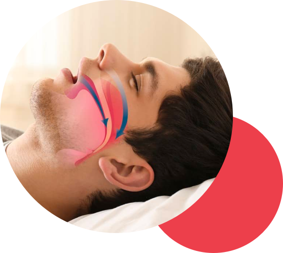 Image illustrating sleep apnea